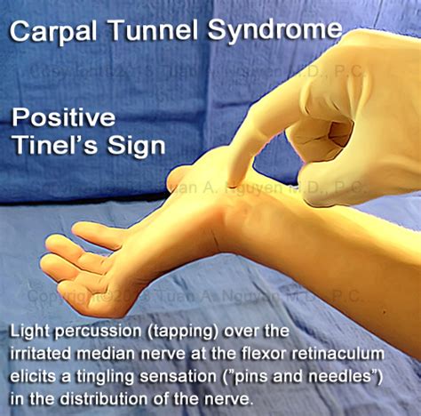 median nerve compression test vs tinels|carpal tunnel conduction test.